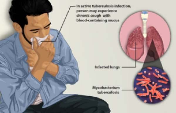 tuberculosis.