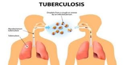 Tuberkolusis. FOTO:Google.